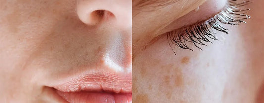 ¿Cómo eliminar las manchas de la piel?